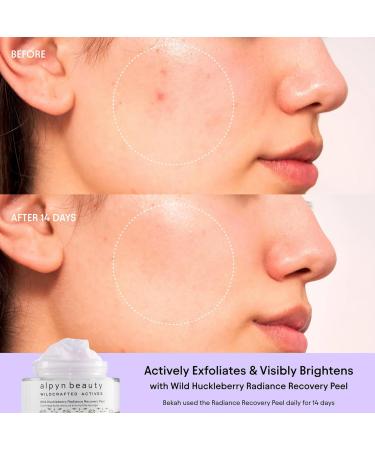 Alpyn Wild Huckleberry Recovery Peel - Exfoliate Moisturize & Soothe Skin | Reduce Redness | 1.7 oz / 50 ml - International Shipping Available - Buy Online on GoSupps.com