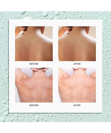 BellamiLuxx Back Acne Treatment Spray - 2% Salicylic Acid & Tea Tree Oil - Herbal Bacne Solution for Men & Women - 4.05 Oz - Buy Online on GoSupps.com