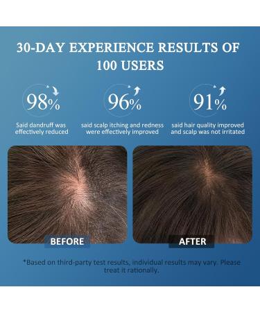  SHVYOG Anti-dandruff shampoo reduces dandruff relieves itching and redness of the scalp antifungal shampoos for seborrheic dermatitis folliculitis leather psoriasis - Buy Online on GoSupps.com