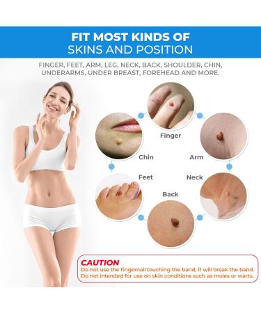 Micro Skin Tag Tool Premier Quality Skin Tag Tool Kit Fast and Easy Skin Tag Tool Kit Painless Skin Tag Kit for Small (2mm) to Medium (5mm) Skin Tags - Safe for Most Parts - Buy Online on GoSupps.com