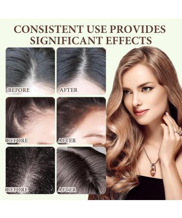 Ginger Anti-hair loss shampoo Anti-hair loss shampoo 3 boxes Hair regrowth shampoo Used to improve dry and frizzy hair (1 massage comb) - Buy Online on GoSupps.com