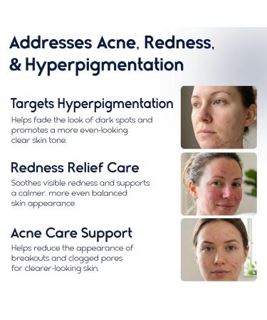 Pharmlitalia Azelaic Acid 15 Acne Cream for Face - Redness Relief Rosacea Treatment for Face - Soothes Acne Hyperpigmentation Enhanced Formula for Brighter Healthier Skin Care - Buy Online on GoSupps.com