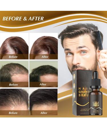 Hair Serum for Hair Growth Ginger Hair Regrowth Serum Ginger Hair Growth Oil for Thinning Repair Hair Follicles Hair Growth Oil for Hair Rapid Growth and Thickening Trengthen Hair Roots 20ML - Buy Online on GoSupps.com