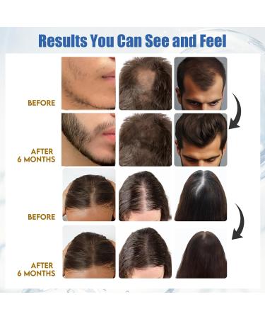 Yuaben Minoxidil Foam for Men & Women - 5% Biotin Infused Extra Strength Hair Regrowth Treatment - Combat Hair Loss - Buy Online on GoSupps.com