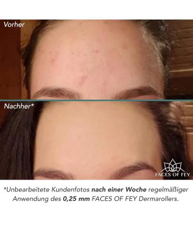 Microneedling Set Faces of Fey - 192 Real Needles Dermaroller Hyaluron Serum & Sanitizer - 0.5mm Nadel Roller for Face & Body Tightening & Modeling - Buy Online on GoSupps.com