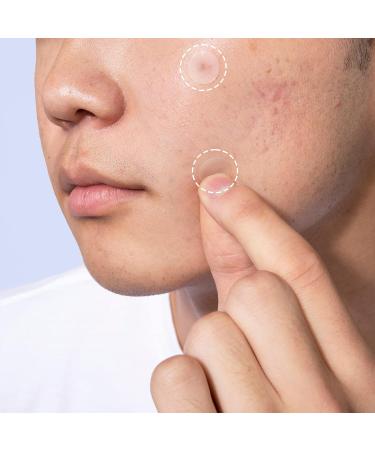 Hanhoo Extra Strength Blemish Patch | Hydrocolloid Acne Spot Treatment with Salicylic Acid | Vegan & Cruelty-free | 36 Count - Buy Online on GoSupps.com
