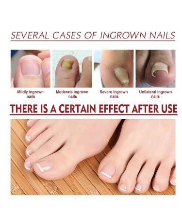 Top Nail Fungus Treatment: German ToenailPlus Kaluofan & More Effective Anti Paronychia Relief & Nail Care - Buy Online on GoSupps.com