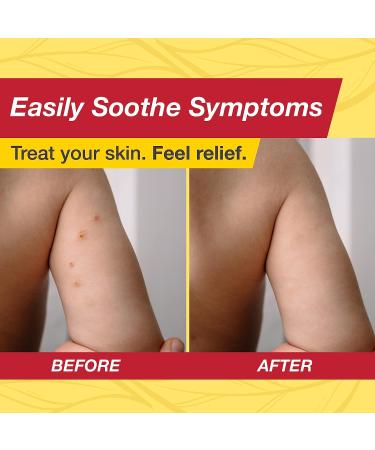 ZYMADERM Molluscum Contagiosum Treatment - Fast-Acting Discomfort-Free Reducer for Kids and Adults - Buy Online on GoSupps.com