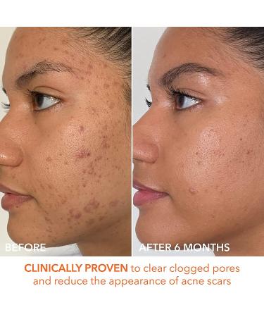 Dr. Dennis Gross Alpha Beta Extra Strength Daily Peel for Oily Skin - 60 Treatments | Targets Uneven Tone, Texture, Wrinkles & Pores - Buy Online on GoSupps.com