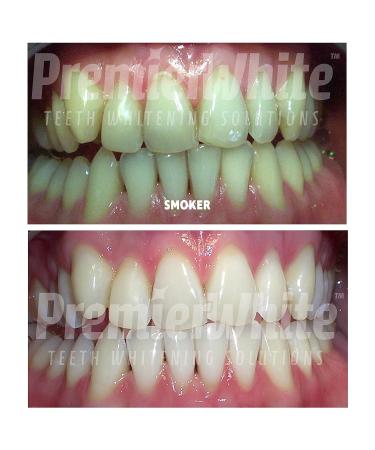 Premiere White Teeth Whitening Pens - 3 Pack - 36% Carbamide Peroxide - Satin Finish Solution - Buy Online on GoSupps.com