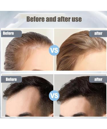 Derma Roller 0.5 mm Needles Beard Roller 1200 Titanium Microneedling Roller Derma Roller for Men and Women Hair Care Face and Body Stretch Marks Hair Loss - Buy Online on GoSupps.com