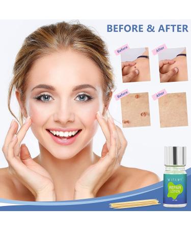 Skin Tag & Mole Remover Kit - Remove Without Scars | Skin Tag Removal Lotion & Silicone Scar Sheet - Buy Online on GoSupps.com