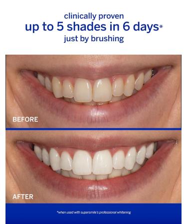 Supersmile Original Mint Teeth Whitening Travel Kit - Brighten Your Smile Anywhere | Buy Now - Buy Online on GoSupps.com
