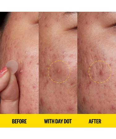 PEACE OUT Acne Day Dot | 6-Hour Fast-Acting Pimple Patch with Salicylic Acid | Clear Breakouts & Blemishes in Hours (20 Dots) - Buy Online on GoSupps.com