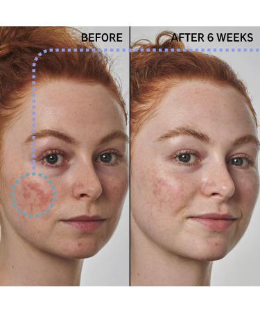 INKEY List Azelaic Acid 10% Serum - Fast-Absorbing Solution for Redness & Soothing Skin - 1.01 fl oz - International Shipping Available - Buy Online on GoSupps.com