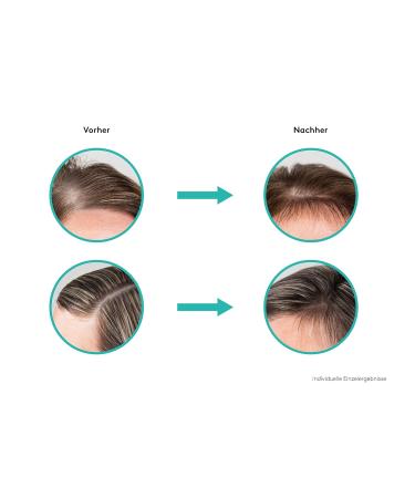 Re-Actin Hair Growth Activator Tonic 100ml - Boost Hair Growth | Fast Shipping Worldwide - Buy Online on GoSupps.com