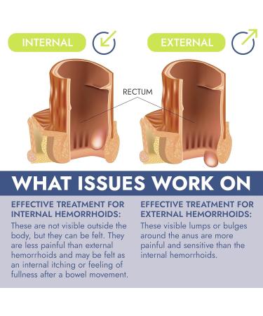 Hemorrhoid Treatment Ointment - Fast Relief for Pain Swelling & Itching | 7 Pre-Filled Applicators | Effective Fissure Care - Buy Online on GoSupps.com