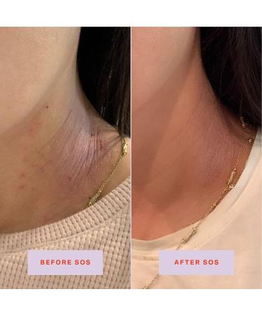 Tower 28 SOS Daily Facial Spray | Travel-Size | Soothe Irritation and Inflammation | pH Balancing Toner | Hypochlorous Acid | 1 Fl Oz - Buy Online on GoSupps.com