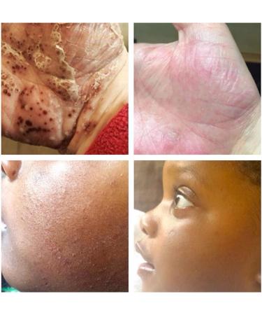 Bria 100% Natural Organic Soothing Balm for Eczema, Dry Skin - 120ml | Adults, Children & Babies | Scent-Free - Buy Online on GoSupps.com