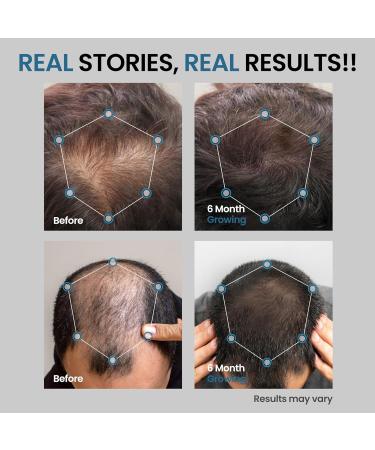 Hair Growth Oil for Men - Minoxidil 5% Serum with Biotin | Extra Strength Hair Regrowth Treatment - Buy Online on GoSupps.com