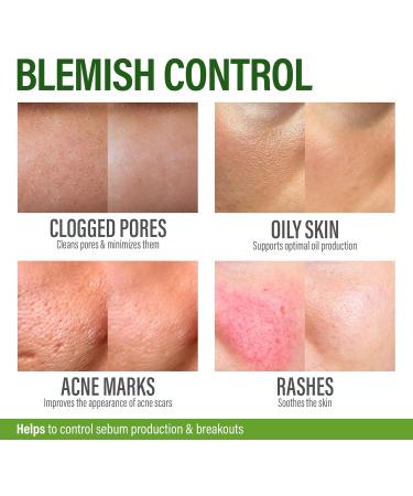 Perfect Skin Acne Pills - Clear Skin Supplement with Niacinamide Probiotic Zinc & Vitamin A - Anti Acne Vitamins for Teens Men & Women - Support for Face & Back Acne Acne Scars - 60 Capsules - Buy Online on GoSupps.com