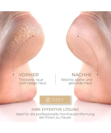 Essy Horn Skin Remover - Best Electrical Test Winner | 5 Replacement Rolls | Ultimate Foot Care & Pedicure Device - Buy Online on GoSupps.com