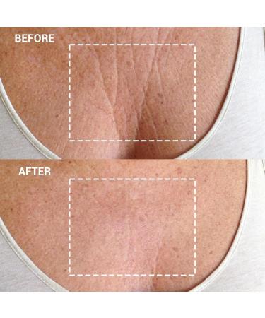 Wrinkles Schminkles Neck & Chest Patch Set - Hyaluronic Silicone Smoothing Pads for Wrinkles Stretch Marks and Cleavage Care | Reusable & Hypoallergenic - Buy Online on GoSupps.com