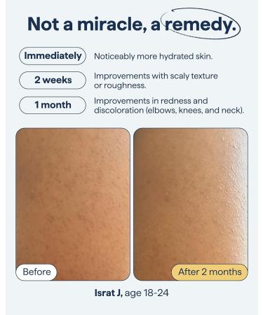 Remedy for Body Bumps | KP Exfoliating Body Moisturizer | Keratosis Pilaris (KP) Treatment For Textured Crepey Skin with Urea Lactic Acid Retinol | Smoothing Body Lotion | By Dermatologist Dr. Shah - Buy Online on GoSupps.com