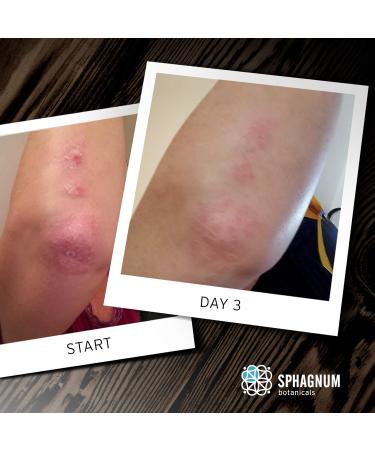 Eczema Body Wash & Cream 2in1 - Peat Mud and Olive Oil Shower Cream. Sulfate Free Treatment for Very Dry & Itchy Skin. Best for Relieving Psoriasis. 250ml - Buy Online on GoSupps.com