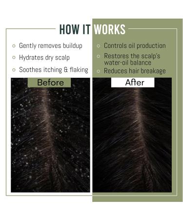 Anti-Dandruff Shampoo & Conditioner Set - 500ml | Soothe Dry Flaky Scalps & Clear Flakes International Shipping Available - Buy Online on GoSupps.com