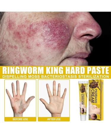 Zemibor Revitaskin Eczema Treatment Cream - Psoriasis Relief for Adults (3pcs) - Buy Online on GoSupps.com