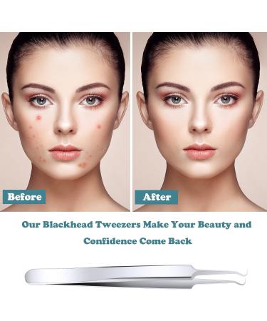 ANCIRS 6 Pack Blackhead Pimple Remover Tweezers Set - Stainless Steel Curved Extractors Tool for Acne Blemish Removal, Silver Color - Buy Online on GoSupps.com
