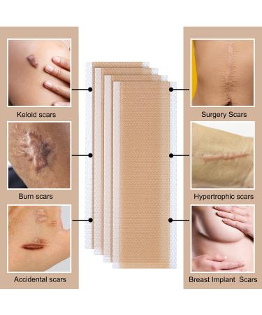Krucasano Advanced Silicone Scar Sheets - 4 Reusable Sheets for Surgery, C-Section, Burn, Keloid, Acne, Old & New Scars - Hypertrophic Scar Removal - Buy Online on GoSupps.com