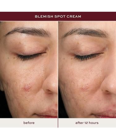 ITK Skincare Salicylic Acid Acne Spot Treatment for Face Back & Body - Fast Active Acne Relief - Pimple Cream for Acne Prone Skin - Clear Blemishes Fast with Tea Tree Oil - 0.5oz - Buy Online on GoSupps.com
