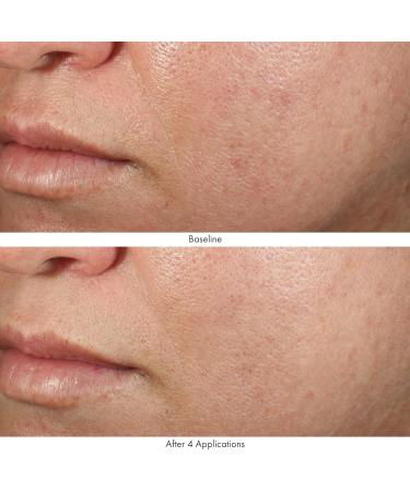 Obagi Medical Revivify Multi-Acid Facial Peel - Shop Internationally for Radiant Skin - Buy Online on GoSupps.com