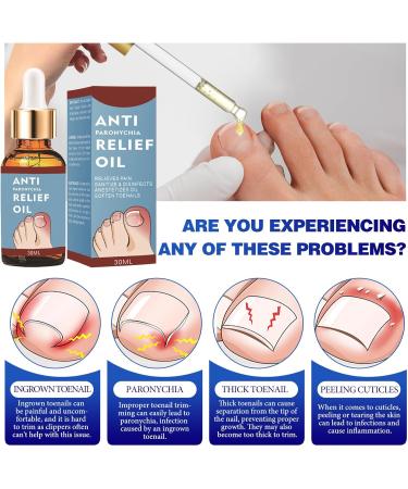 Ingrown Toenail Treatment 30ml Ingrowing Toenail Treatment Toenail Anti Paronychia Relief Oil Correction Ingrown Toenail Softening Drops for Damaged Discolored Thick Nail - Buy Online on GoSupps.com