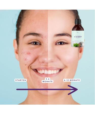 Inositol Fem Acnesitol 3000mg - Hormonal Acne Solution Female Balance | 14-in-1 Formula with Myo & D-Chiro Inositol NAC Niacin Vitamin A Selenium Zinc Chromium & BioPerine - Buy Online on GoSupps.com