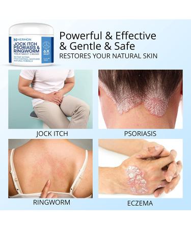Antifungal Cream for Jock Itch, Psoriasis & Ringworm Treatment - 100g - Buy Online on GoSupps.com