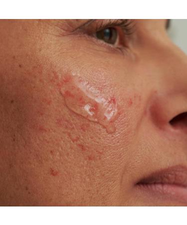 DADO SENS SENSACEA INTENSION SERUM Special size 75ml mild care for hypersensitive skin with a tendency to couperosis up to the first signs of rosacea and mild to moderate redness - Buy Online on GoSupps.com