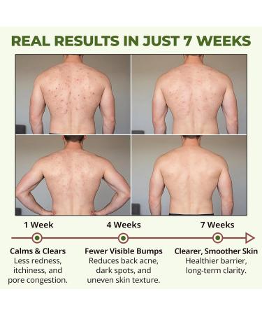 ABERA High-Performance Folliculitis Body Wash with Wild Bitter Melon Extract, BHA Shower Gel, Reduces Back Acne & Keratosis Pilaris, Folliculitis Treatment, Acne Body Wash for Sensitive Skin, 10.14 oz A. 1 Box - Buy Online on GoSupps.com