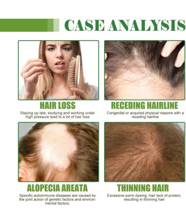 Shelure Hair Regrowth Oil 60ml Hair Growth Oil Hair Regrowth Treatment Makes Hair Stronger Thicker Nourishes Thinning Hair - Buy Online on GoSupps.com