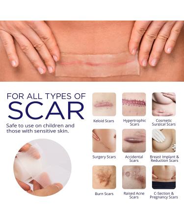 Advanced Silicone Scar Sheets Roll - Medical Grade Gel Tape for Scar Removal - Transparent, Comfortable, Painless - 1.6inch x 60inch Roll - New & Old Scars - Buy Online on GoSupps.com