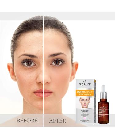 FLOSLEK Whitening Brightening Face Acid Night Peeling | 30 ml | Lightens Moisturizes Softens & Evens Skin Colour | Smoother & Brighter Complexion | Reduces the Intensity of Blemishes - Buy Online on GoSupps.com