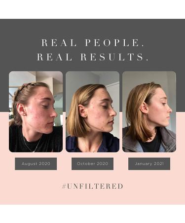 Averr Aglow Clear Skin Elixir Face Mask - Prevent Breakouts, Clear Acne & Oily Skin, Fade Scars & Marks | Natural Skincare Solution for Reducing Pores and Achieving Younger Looking Skin - Buy Online on GoSupps.com