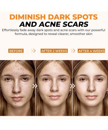 20% Vitamin C Face Serum - Anti-Aging Hyaluronic Acid Retinol & Collagen for Dark Spots & Wrinkles - 30ml - Buy Online on GoSupps.com