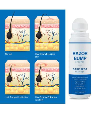 Razor Bump Stopper & Dark Spot Remover: Ingrown Hair Treatment for Men & Women - Buy Online on GoSupps.com