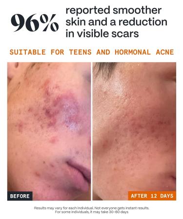 Norse Organics | The Complete System for pimples 2.0 | 4 Step Kit with Arctic Herbs & Beeswax | Day Night Balms Scar Healer Scrub | Natural Face Care for All Skin Types | Full Size - Buy Online on GoSupps.com