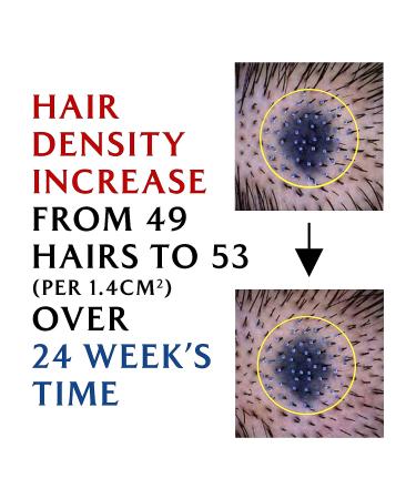 LA'DOR Dermatical Hair-Loss Shampoo - 17.9 fl.oz. Salicylic Acid & Dexpanthenol for Normal to Dry Hair - Buy Online on GoSupps.com