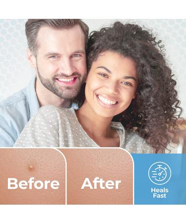 Acne Patches (120 Pack) with Salicylic Acid & Tea Tree Oil - Hydrocolloid Pimple Stickers for Face - Blemish Spot Treatment - 3 Sizes - Buy Online on GoSupps.com