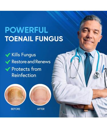 Extra Strength Toenail Fungus Treatment - 25% Undecylenic Acid & Tea Tree Oil | 4Pcs Antifungal Nail Solution for Thick Damaged Nails - Buy Online on GoSupps.com